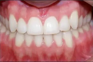 porcelain veneers smile three after