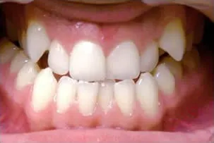 porcelain veneers smile three before