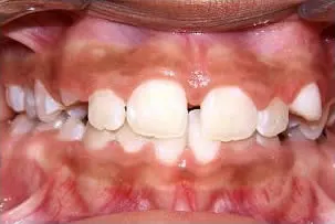 porcelain veneers smile one after