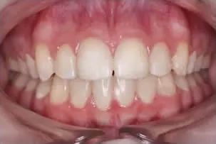 porcelain veneers smile three after